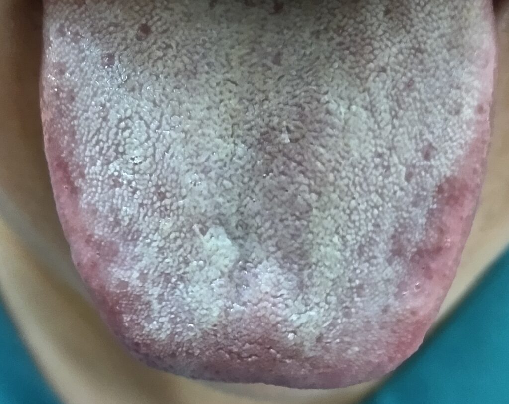 生葉知覚過敏ケアで磨いた後の舌